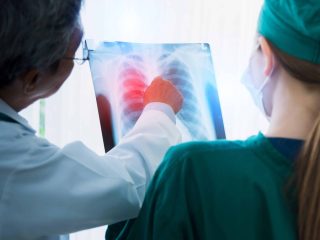 La importancia del diagnóstico precoz del cáncer pulmonar