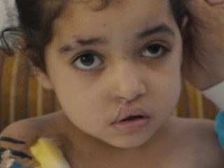 La niña de 6 años que ha sido sometida a más de 20 cirugías: Una tragedia humanitaria en Gaza